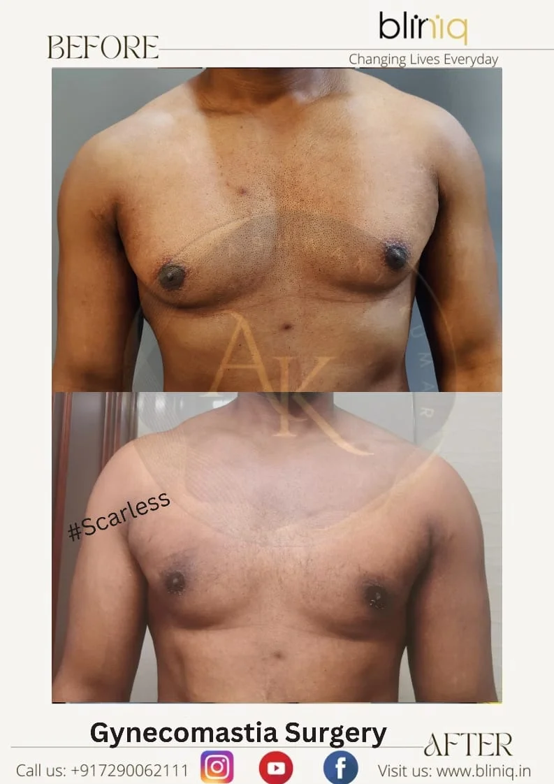 Gynecomastia Correction — Case 6
