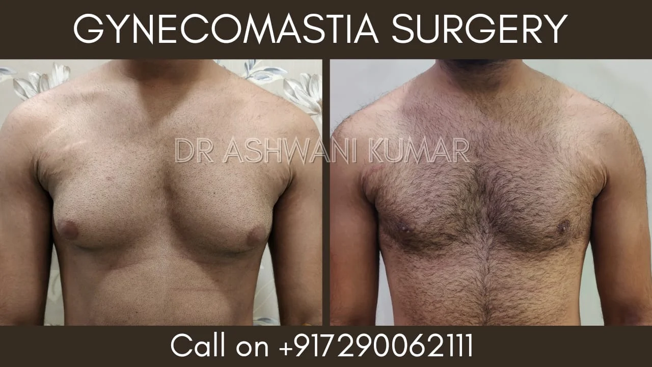 Gynecomastia Correction — Case 9