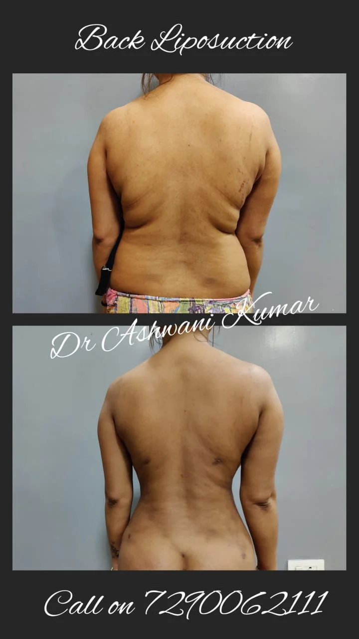 Back Liposuction — Case 1