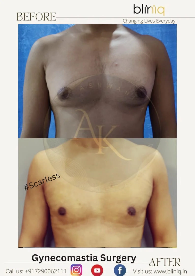 Gynecomastia Correction — Case 16