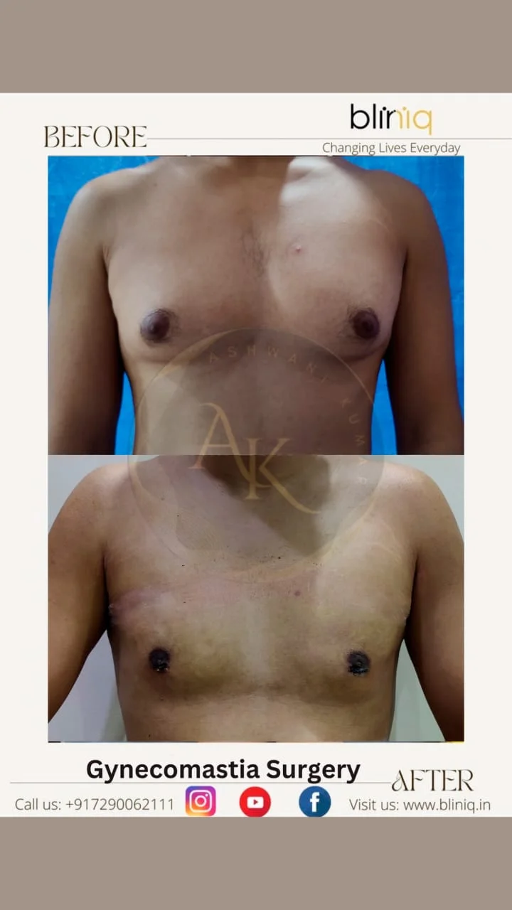 Gynecomastia Correction — Case 18